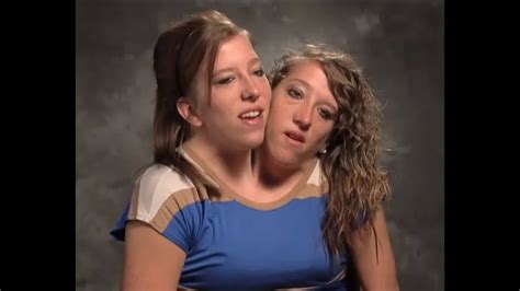 conjoined twins porn|conjoined twins Search